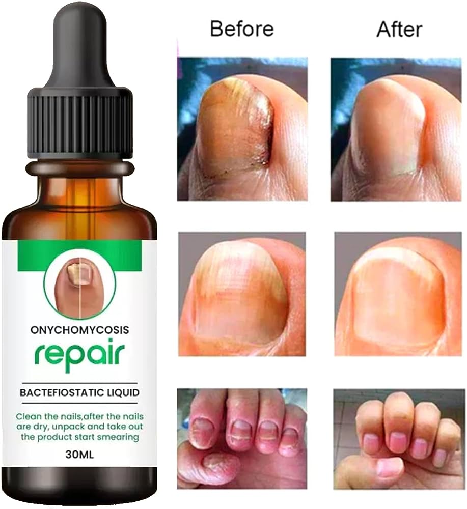 Nail Growth Repair Serum - Buy1 & Get1 Free